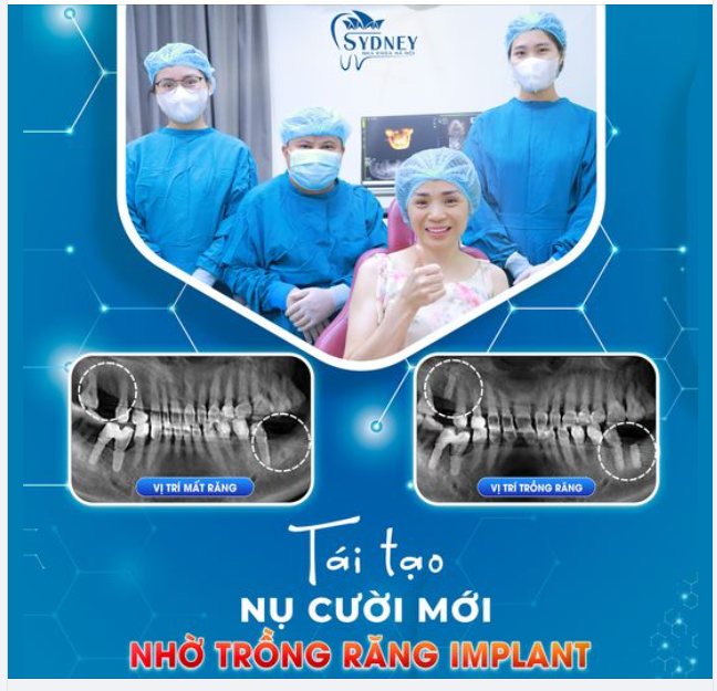 TÁI TẠO NỤ CƯỜI NHỜ TRỒNG RĂNG IMPLANT
