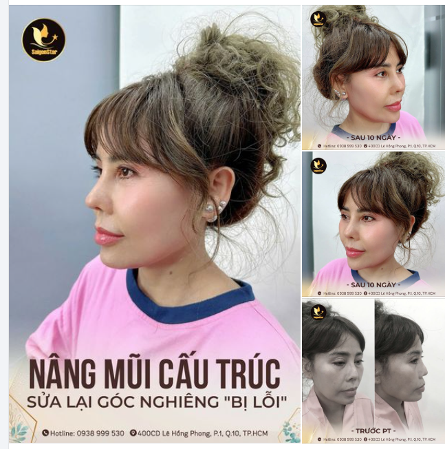 NÂNG MŨI CẤU TRÚC - HOÀN THIỆN GÓC NGHIÊNG BỊ LỖI CHỈ SAU 10 NGÀY