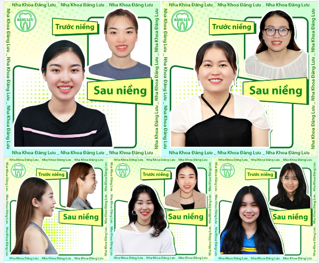 Ai Sẽ Là Miss Niềng Răng Của Nha Khoa Đăng Lưu?