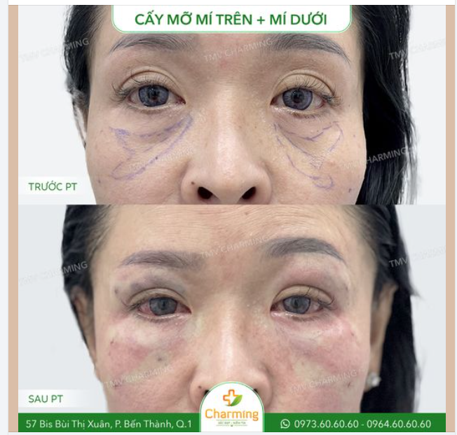 Nàng khách có tình trạng mí mắt trên và dưới lộ rõ dấu hiệu lão hóa, vùng da quanh mắt bị chùng nhão, đặc biệt là hốc mắt dưới bị hõm sâu, tạo cảm giác mệt mỏi và thiếu sức sống.