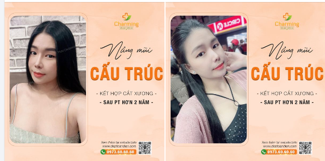 Nàng khách của Charming vẫn xinh bất chấp với chiếc mũi cấu trúc sụn sườn và cắt xương đã từng trải qua sửa lại lần hai.