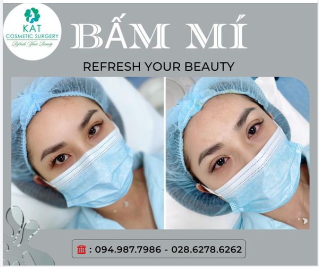 BẤM MÍ : Sự lựa chọn hoàn hảo cho những bạn có đôi mắt không đều, có ít da dư và mỡ thừa, những cô nàng mắt một mí, nhiều mí lót nhưng vẫn muốn sở hữu đôi mắt hai mí to tròn.