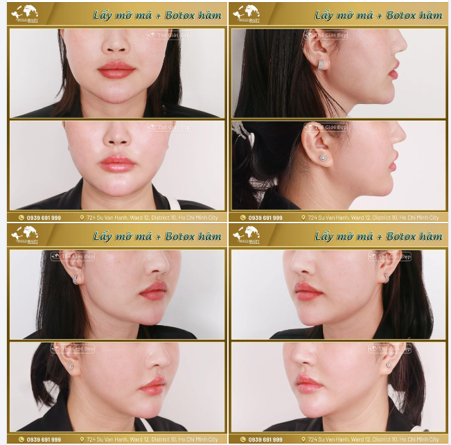 MÁ PHÍNH BẦU BĨNH hóa V.line THON GỌN bằng combo ph.ẫu thuật lấy túi mỡ má + Botox hàm
