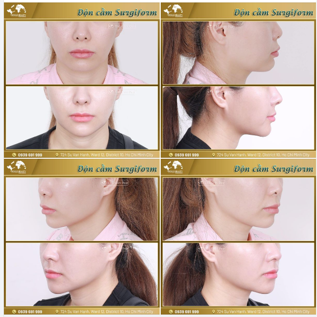 Với kĩ thuật hiện đại và tiên tiến ngày nay ph.ẫu th.uật đ.ộn cằm không để lại Sẹo. Bởi quá trình phẫu thuật sẽ được thực hiện hoàn toàn bên trong khoang miệng.