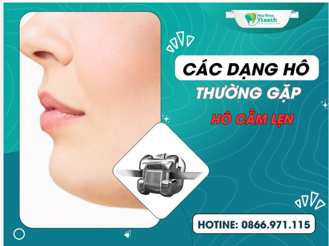 Các rạng hô thường gặp  - Răng hở cằm lẹm