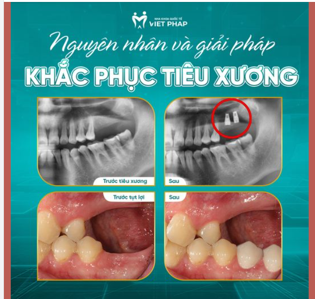 NGUYÊN NHÂN VÀ GIẢI PHÁP KHẮC PHỤC TIÊU XƯƠNG