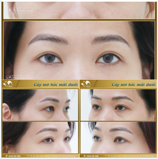 Cấy mỡ tự thân hốc mắt là phương pháp sử dụng những tế bào m.ỡ thừa khỏe mạnh ở một số vùng trên cơ thể như: đùi, bắp tay, bụng... của chính Khách hàng để cấy ghép, làm đầy vùng hốc mắt trũng sâu.