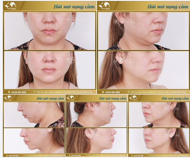 Sở hữu một gương mặt V-line, thanh tú giải pháp hút mỡ nọng cằm là một lựa chọn tối ưu và hiệu quả.