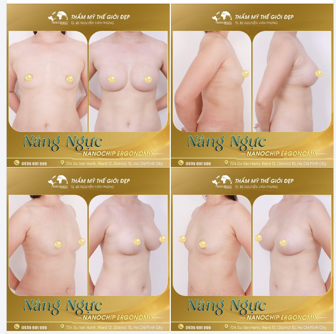 Ngực tự nhiên của khách hàng:  Hai bầu ng.ực khác nhau, không đều. Khoảng cách khe ngực rộng. Thể tích 2 bầu ng.ực khiêm tốn, ít mô tuyến vú, nhỏ lép.