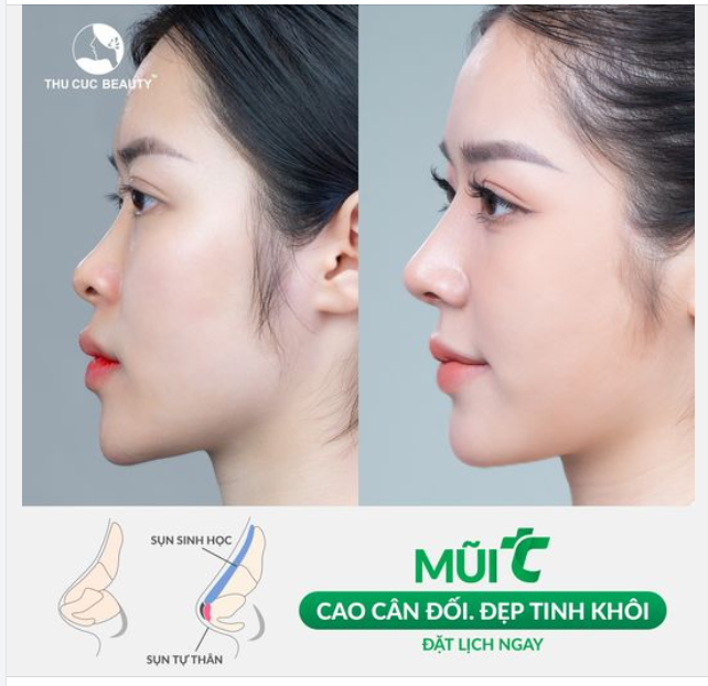 Deal cho chị em trong tháng này Nâng Mũi TC 11.9tr