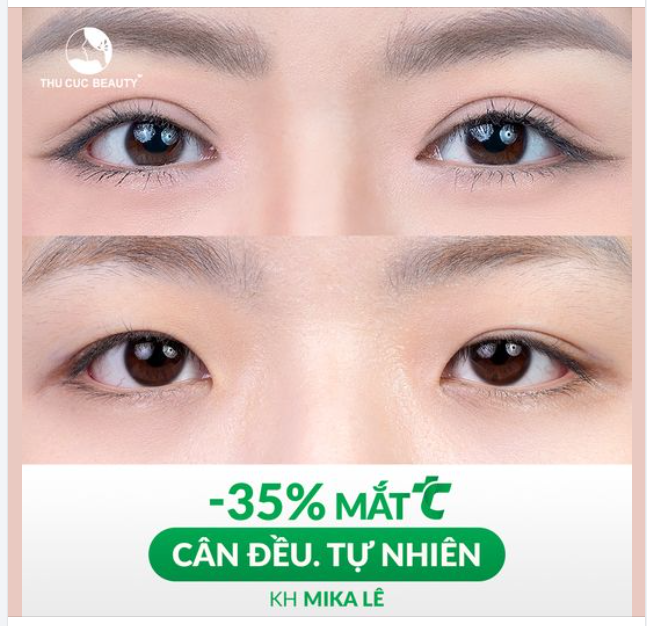 Thay đổi sau cắt mí chỉ 15 phút đã làm thay đổi cả diện mạo