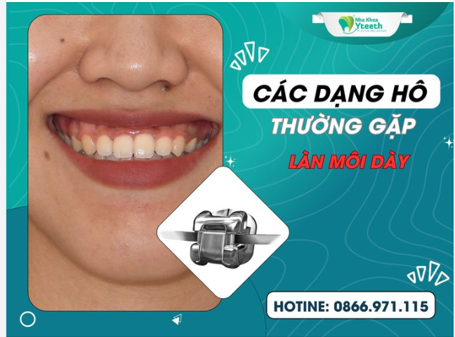 Các dạng hô thường gặp - Làn môi dày
