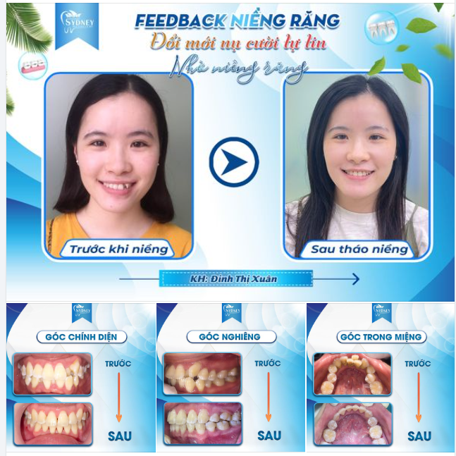 ĐỔI MỚI NỤ CƯỜI TỰ TIN NHỜ NIỀNG RĂNG