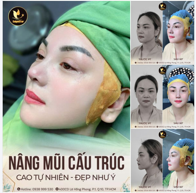 NÂNG MŨI CẤU TRÚC SỤN SURGIFORM Chị khách trẻ ra 10 tuổi sau 60 phút thực hiện.