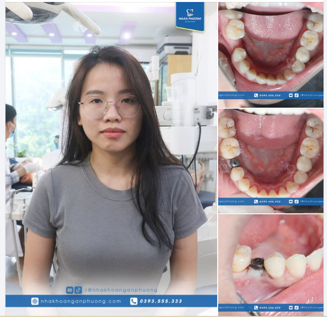 Đừng chủ quan! Tuổi nào cũng có thể tiêu xương