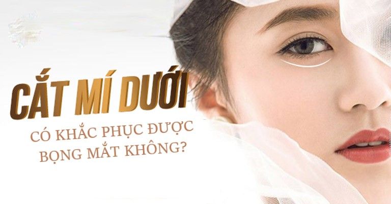 CẮT MÍ DƯỚI CÓ KHẮC PHỤC ĐƯỢC BỌNG MẮT KHÔNG?