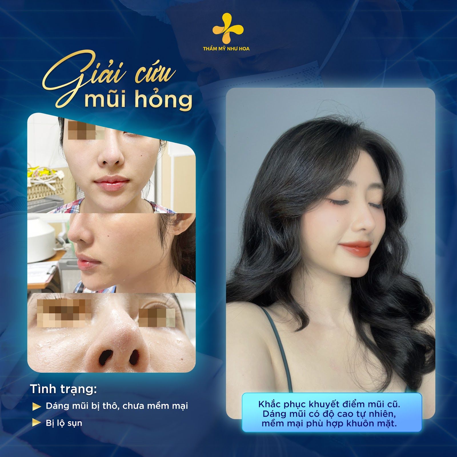 Dấu hiệu lòi sụn mũi: Nguyên nhân và cách khắc phục hiệu quả