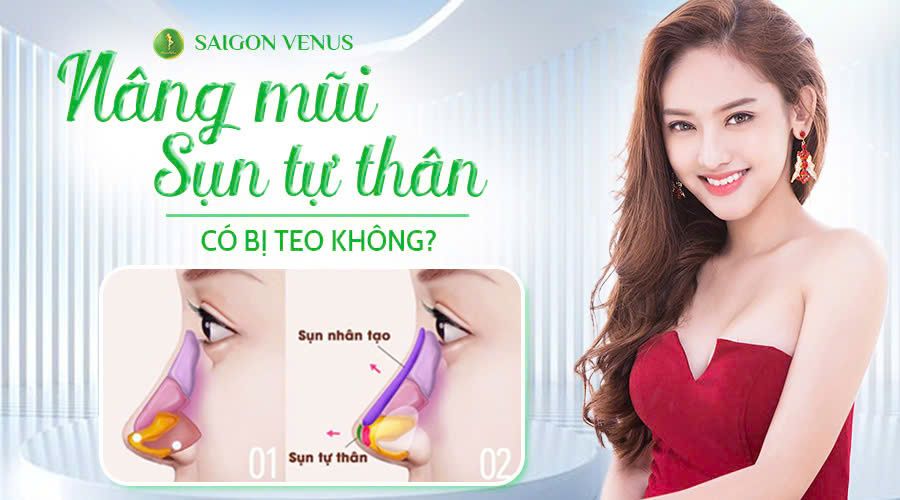 NÂNG MŨI SỤN TỰ THÂN CÓ BỊ TEO KHÔNG