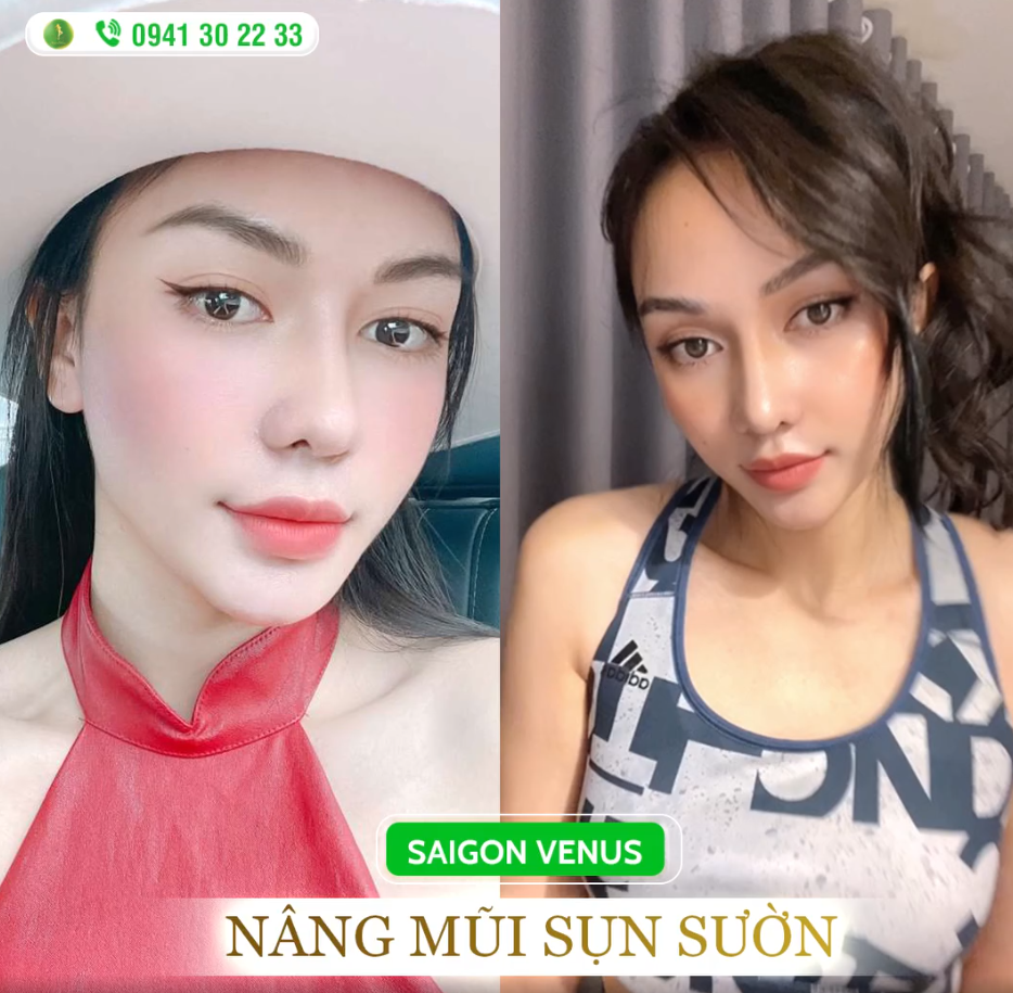 VÌ SAO MŨI SỤN SƯỜN NGÀY CÀNG PHỔ BIẾN?