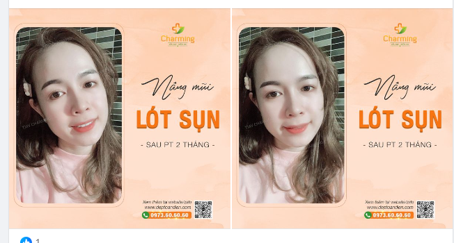 Sau khi nàng nâng mũi cao,  Sụn lót tinh tế, đẹp sao dáng hình.  Hai tháng sắc thắm lung linh,  Mũi xinh, cánh gọn, tự tin mỗi ngày.