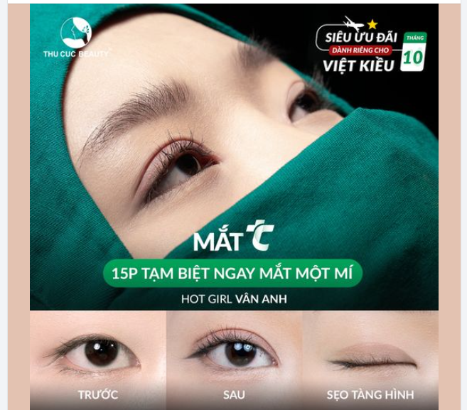 Hô biến mắt một mí hóa hai mí cân đều, tự nhiên Việt Kiều về nước nên Cắt mí ở đâu?