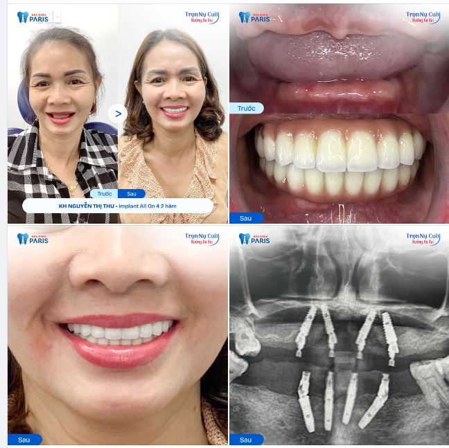 "TRỒNG RĂNG IMPLANT KHÔNG ĐAU DÙ CÔ ĐÃ LỚN TUỔI"