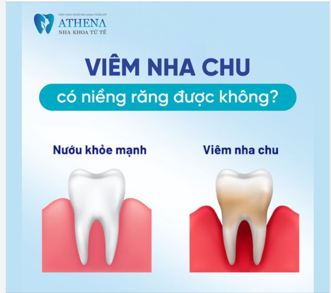 Viêm nha chu có niềng răng được không?