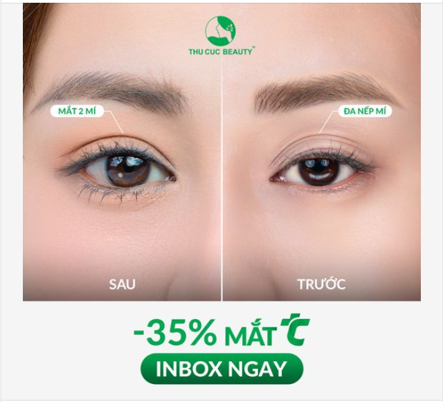 Hình ảnh trước và sau cắt mí của khách hàng
