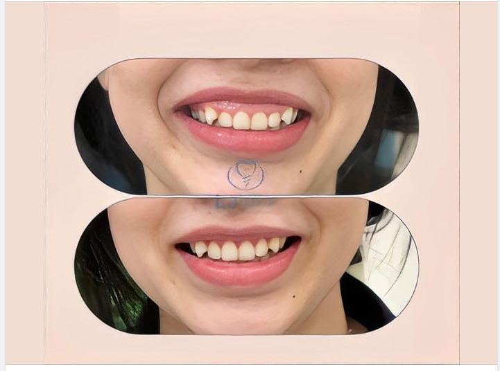 VÌ SAO NÊN ĐIỀU TRỊ CƯỜI HỞ LỢI?
