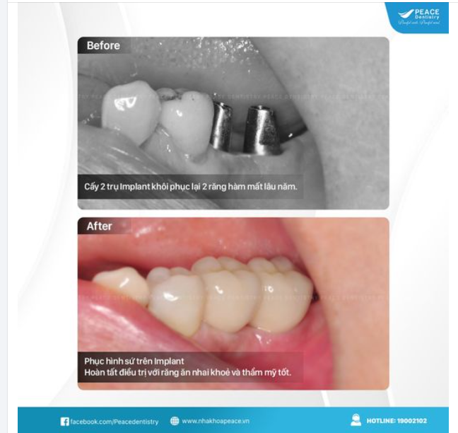 KHÔI PHỤC RĂNG TRỌN VẸN VỚI CẤY GHÉP IMPLANT