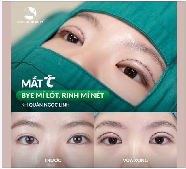 Sở hữu nếp mí sắc nét, hai mí cân đều Chọn Mắt TC