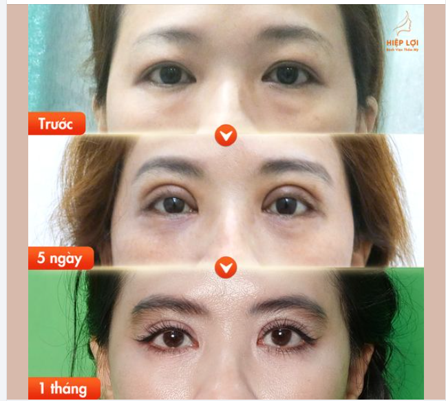 Nếu khách hàng nào lo lắng tình trạng SƯNG BẦM sau khi "cắt mí" thì xem nhanh hình thực tế của khách hàng nhà Hiệp Lợi dưới đây để yên tâm hơn ạ.