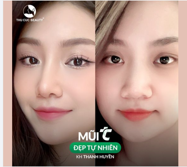 Dáng mũi tự nhiên. Độ cao vừa phải. Không lộ sụn