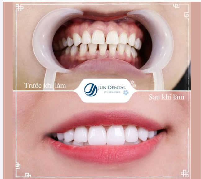 TẠM BIỆT RĂNG THƯA - ĐÓN NỤ CƯỜI RẠNG RỠ