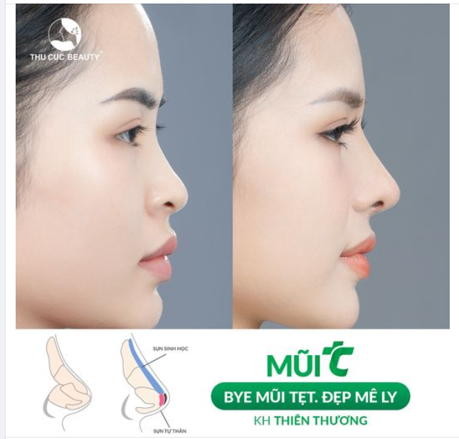 Nâng mũi TC giá cả hợp lý chi phí cực hời