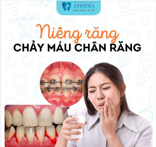 Chảy máu chân răng sau khi niềng là tình trạng mà một số người có thể gặp phải.