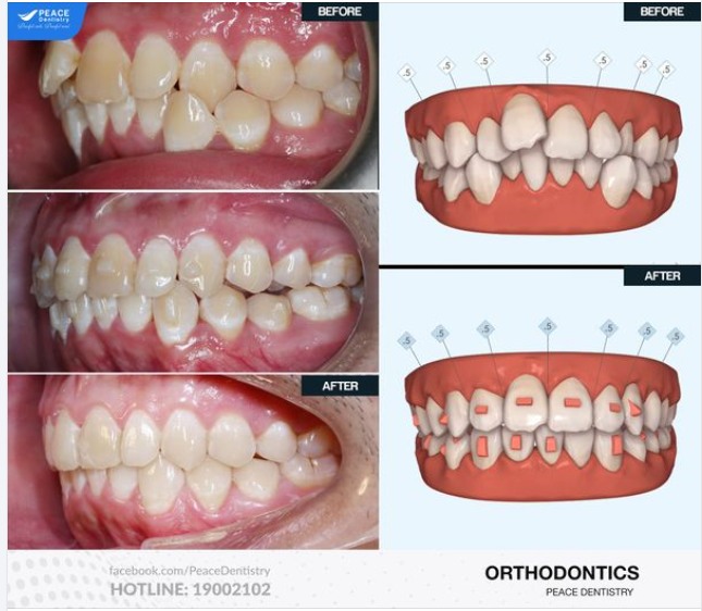 Ca lâm sàng: Niềng răng Invisalign cho khách hàng nam 20 tuổi