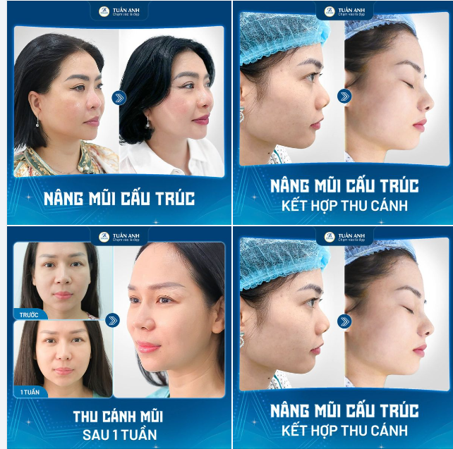 Nâng mũi và thu cánh mũi – Bí quyết để vẻ đẹp trở nên khác biệt! ​​​​​​​