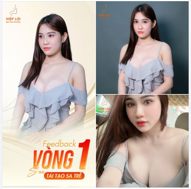  Feedback của khách hàng nhà Hiệp Lợi sau TÁI TẠO SA TRỄ kết hợp ĐẶT TÚI NGỰC