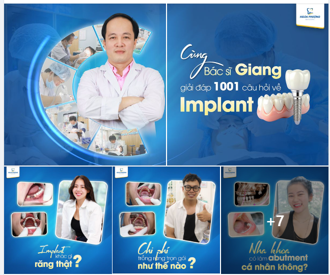 Implant và 1001 thắc mắc sẽ được bác sĩ Giang giải đáp tại đây