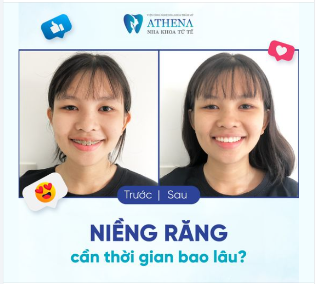 Niềng răng cần thời gian bao lâu