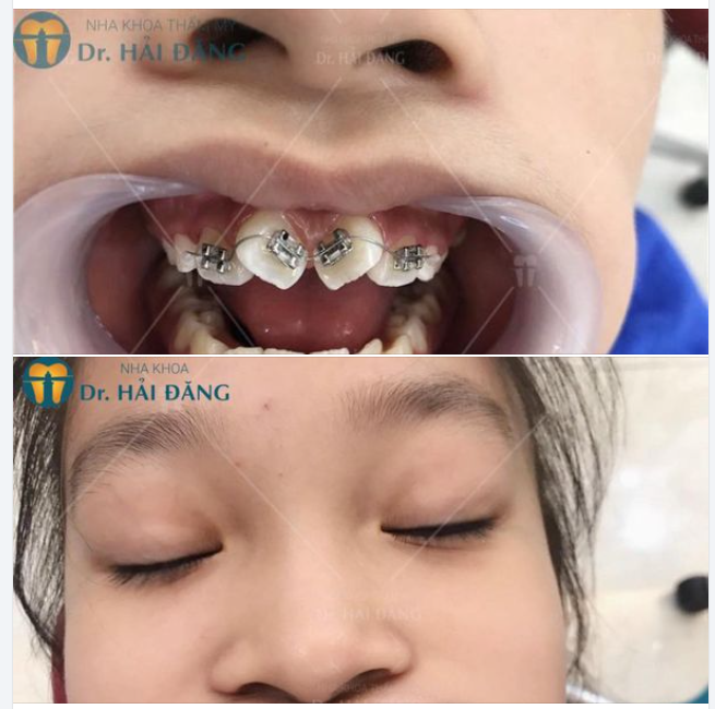 NIỀNG RĂNG SỚM TỰ TIN KHOE CÁ TÍNH