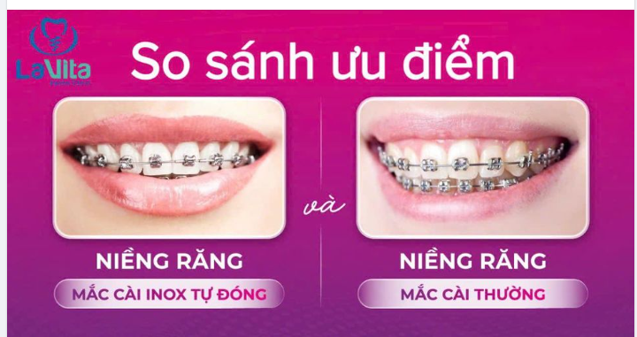 NHỮNG ƯU ĐIỂM NỔI BẬT CỦA NIỀNG RĂNG MẮC CÀI TỰ BUỘC SO VỚI MẮC CÀI THÔNG THƯỜNG