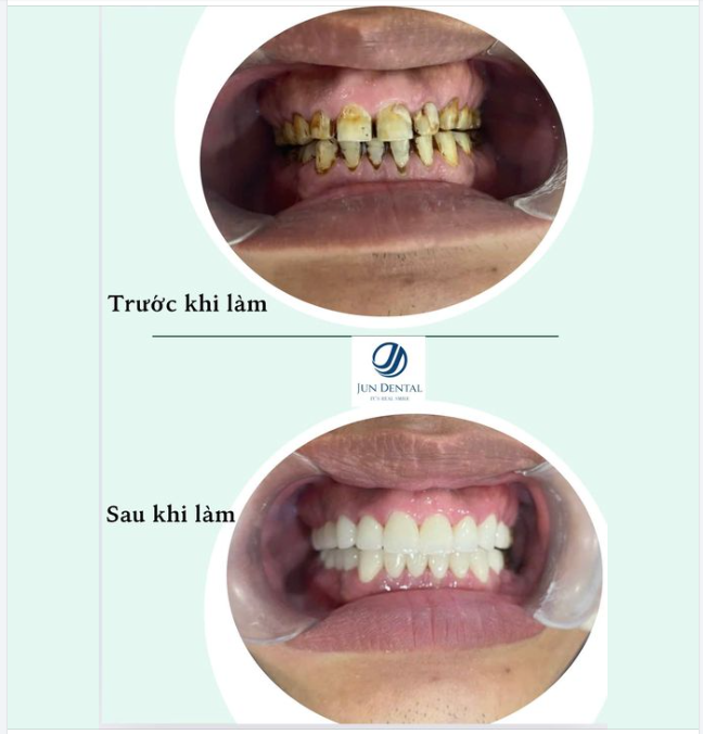TÌM LẠI NỤ CƯỜI NGÀY TRẺ NHỜ LÀM RĂNG SỨ