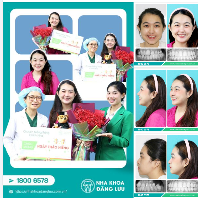 RĂNG XINH RỒI, THÁO NIỀNG THÔI!!!