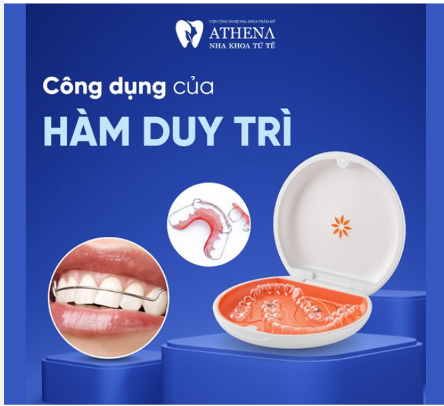 Tại sao hàm duy trì lại quan trọng trong niềng răng