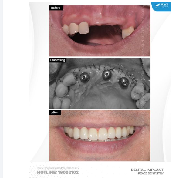 SAU 7 NGÀY VỚI CA LÂM SÀNG IMPLANT PHỤC HÌNH TỨC THÌ