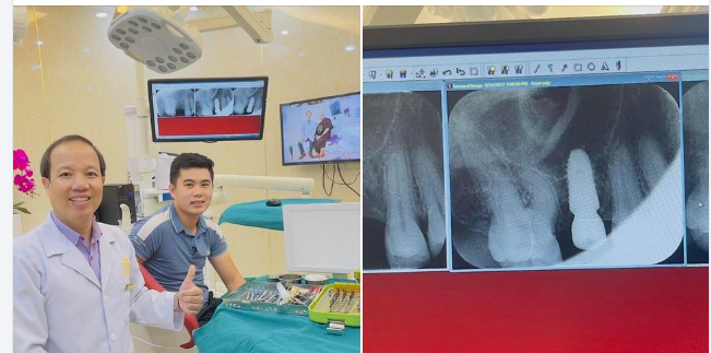 ĐIỀU KIỆN CẦN ĐỂ CẤY GHÉP IMPLANT