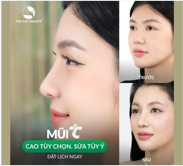 Khách hàng có sống mũi thấp, cánh mũi to bè được cải thiện chỉ sau 30P