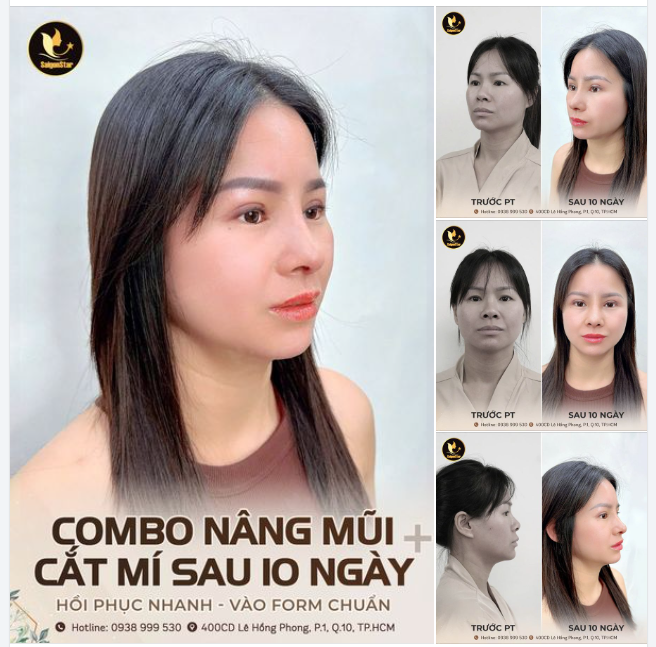 10 NGÀY NÂNG MŨI + CẮT MÍ  XÓA BỎ PHIÊN BẢN TỰ TI CỦA CHÍNH MÌNH